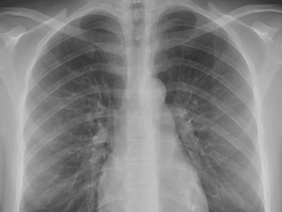 Chest X-ray with both lungs and the heart outlined as segmentation masks